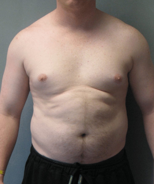 Pseudogynecomastia Before Photo Pseudogynecomastia