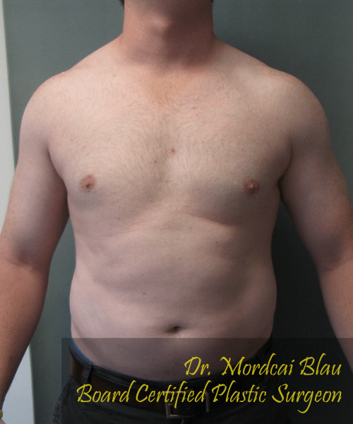 Pseudogynecomastia After Photo Pseudogynecomastia