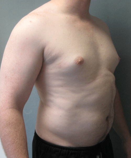 Pseudogynecomastia