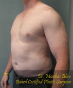 Pseudogynecomastia