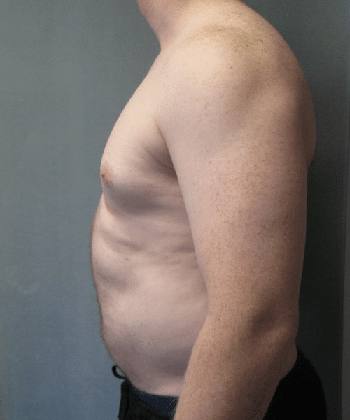 Pseudogynecomastia