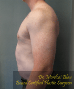 Pseudogynecomastia