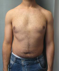 Pseudogynecomastia