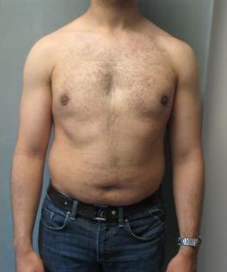 Pseudogynecomastia