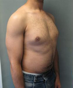 Pseudogynecomastia