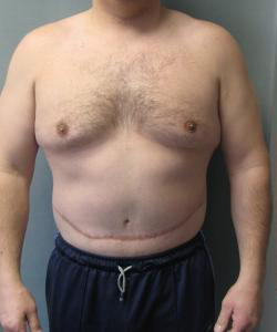 Pseudogynecomastia