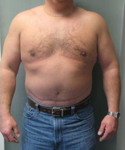 Pseudogynecomastia After Photo Pseudogynecomastia