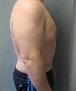 Pseudogynecomastia