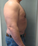 Pseudogynecomastia