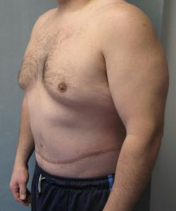 Pseudogynecomastia