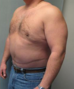 Pseudogynecomastia