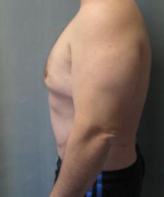 Pseudogynecomastia