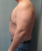 Pseudogynecomastia