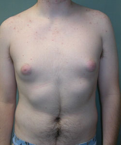 Dr. Blau's patient results for gynecomastia/ male breast reduction and puffy nipples in New York City