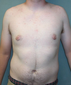 Dr. Blau's patient results for gynecomastia/breast reduction and puffy nipples  in New York City