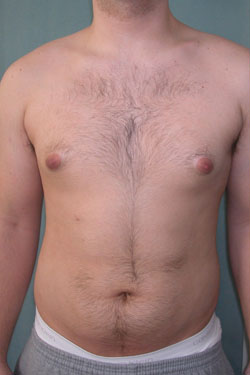 Puffy Nipples Before Photo Puffy Nipples