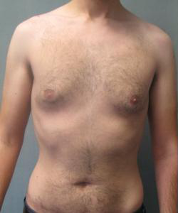 Puffy Nipples Before Photo Puffy Nipples