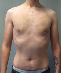 Puffy Nipples After Photo Puffy Nipples