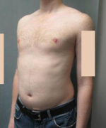 Puffy Nipples