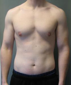 Puffy Nipples Before Photo Puffy Nipples