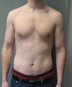 Puffy Nipples After Photo Puffy Nipples