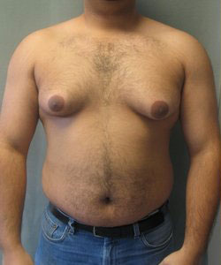 Severe Gynecomastia