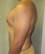 Severe Gynecomastia