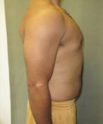 Severe Gynecomastia