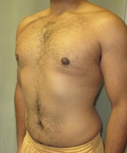 Severe Gynecomastia