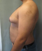 Severe Gynecomastia