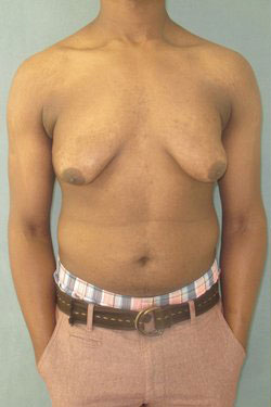 Severe Gynecomastia