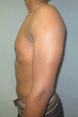 Severe Gynecomastia