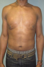 Severe Gynecomastia