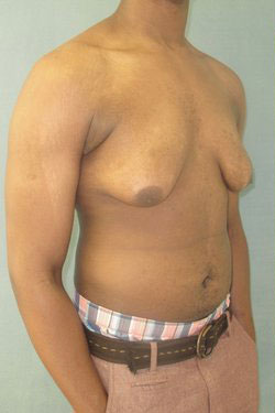 Severe Gynecomastia