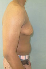 Severe Gynecomastia