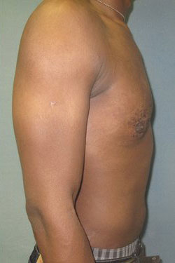 Severe Gynecomastia