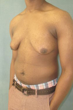 Severe Gynecomastia