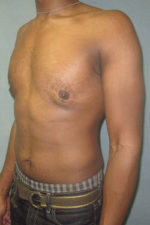 Severe Gynecomastia