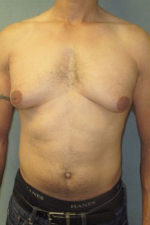 Severe Gynecomastia