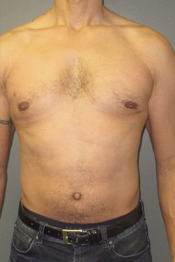 male breast reduction