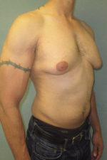 Severe Gynecomastia