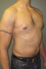 Severe Gynecomastia