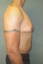 Severe Gynecomastia