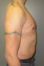 Severe Gynecomastia