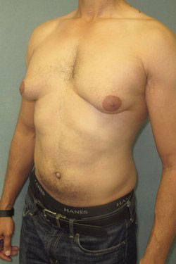 Severe Gynecomastia