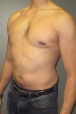 Severe Gynecomastia