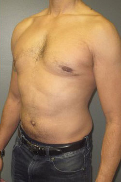 Severe Gynecomastia