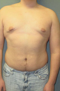 Severe Gynecomastia