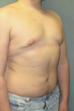 Severe Gynecomastia