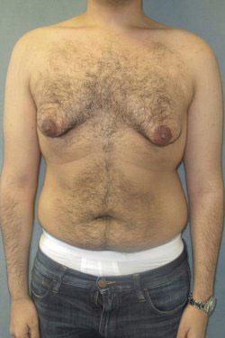 Severe Gynecomastia